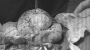 Bóc tách thành công khối u khủng gần 21cm ra khỏi tử cung một phụ nữ