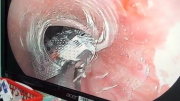 Cứu bệnh nhân bị hóc viên thuốc nguyên vỏ