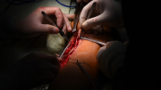 Bệnh viện 30-4 thực hiện ca vi phẫu hồi sinh cánh tay trái cho nam thanh niên