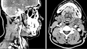 Bị biến dạng khuôn mặt vì khối u hiếm vùng tuyến nước bọt