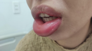 Cô gái nhập viện vì "cặp môi cá ngão" sau khi làm đẹp