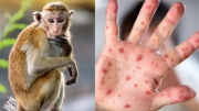 Bộ Y tế đưa đậu mùa khỉ vào danh mục bệnh truyền nhiễm nhóm B