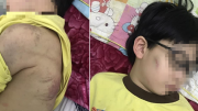 Cháu bé 8 tuổi ở Quảng Ninh bị mẹ bạo hành phải nhập viện