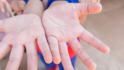 40% trẻ mắc bệnh tay chân miệng do chủng virus nguy hiểm