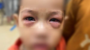 Dịch đau mắt đỏ xuất hiện, nhiều ca biến chứng nặng