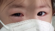 Bệnh đau mắt đỏ bùng phát mạnh, bác sĩ hướng dẫn cách điều trị