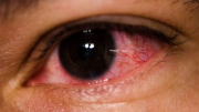 Bộ Y tế đưa ra 5 khuyến cáo phòng dịch đau mắt đỏ