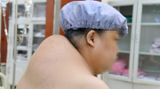 Phẫu thuật khối bướu khổng lồ gây biến dạng vai gáy cho bệnh nhân