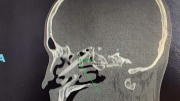 Phẫu thuật lấy đôi đũa đâm xuyên từ mũi vào não bệnh nhân