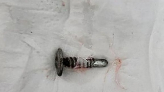 Bé trai gần 3 tuổi nuốt phải đinh vít tử vong