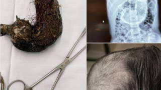 Lấy búi tóc gần 1 kg trong dạ dày bé gái 5 tuổi