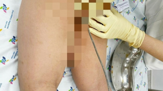 Ca cấp cứu “có một không hai”: Trẻ nhét cây thông cống dài nửa mét vào hậu môn