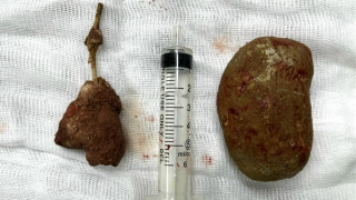 Lấy sỏi bàng quang khủng ra khỏi người bệnh nhân