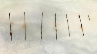 Gắp thành công 7 cây kim trong lồng ngực nữ bệnh nhân