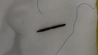 Cắt cỏ, không may bị dây thép đâm xuyên tim