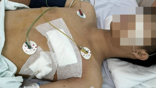 Cứu sống nạn nhân bị đâm thủng tim, phổi