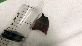 Mảnh xương heo 20 năm trong phế quản người đàn ông