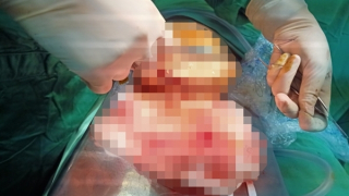 Nối thành công “của quý” bị cắt rời của một phạm nhân