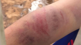 Bà nội cùng cha đẻ nhiều lần đánh đập cháu bé 9 tuổi