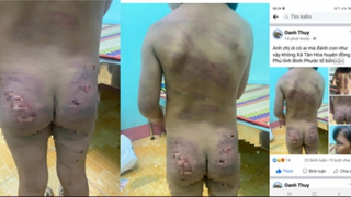 Bé gái 7 tuổi ở Bình Phước nghi bị bạo hành dã man