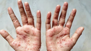 Chủ động tìm nguồn vaccine, thuốc điều trị khi có ca bệnh đậu mùa khỉ xâm nhập