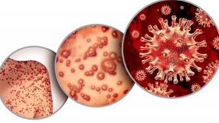 Chưa áp dụng tờ khai y tế tại các cửa khẩu để giám sát bệnh đậu mùa khỉ