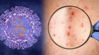 Việt Nam nghiên cứu sản xuất thuốc điều trị bệnh đậu mùa khỉ