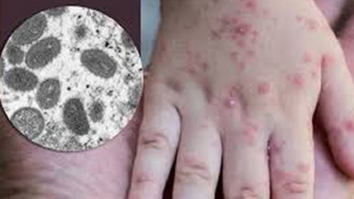 Đo thân nhiệt khách nhập cảnh để phát hiện sớm bệnh đậu mùa khỉ