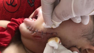 Cháu bé 19 tháng tuổi ở Cà Mau bị chó dại tấn công