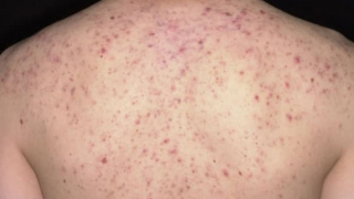 Suýt tử vong vì trị mụn trứng cá ở lưng tại một spa