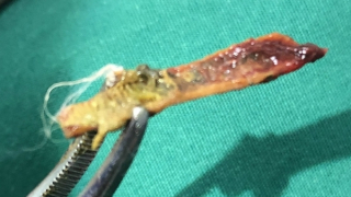 Đi khám trĩ, bất ngờ phát hiện xương gà ở hậu môn