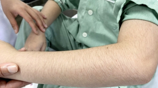 Báo động suy tuyến thượng thận do dùng thuốc xịt mũi, thuốc đông y chứa corticoid