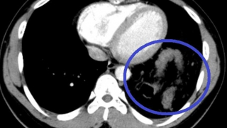 Vỡ cơ hoành khiến đại tràng, dạ dày "chui" lên ngực lại ngỡ hậu COVID-19