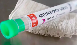 Bộ Y tế gửi văn bản khẩn sau khi phát hiện ca mắc bệnh đậu mùa khỉ