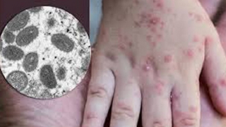 Điều tra người tiếp xúc gần ca nghi nhiễm đậu mùa khỉ tại Đắk Lắk