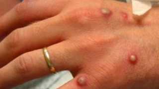 Ca nghi nhiễm đậu mùa khỉ ở Đắk Lắk có kết quả xét nghiệm âm tính