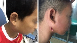 Thiếu niên 15 tuổi ở Thanh Hoá mắc bệnh Whitmore đã tử vong