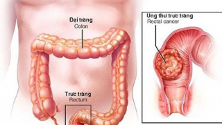 15 tuổi đã mắc ung thư đại tràng, cảnh báo bệnh ngày càng trẻ hóa