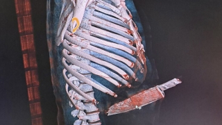 "Nín thở" với ca đại phẫu rút con dao dài ra khỏi bụng người đàn ông