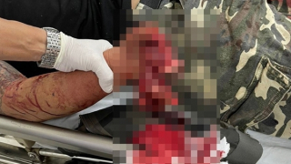 Bị pháo nổ dập nát bàn tay