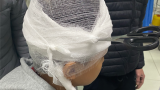 Cứu học sinh lớp 6 bị kéo đâm thủng hộp sọ