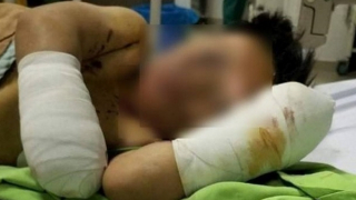 Bé trai 8 tuổi bị cụt 2 tay nghi do nghịch pháo