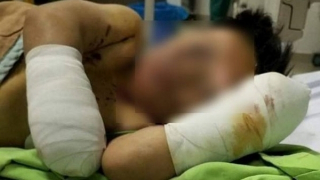 Báo động tình trạng tai nạn thương tích do nổ pháo tự chế