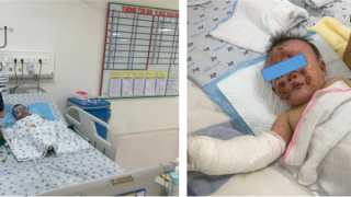 Người nhà bất cẩn, 2 trẻ bị bỏng cồn và nước sôi nghiêm trọng