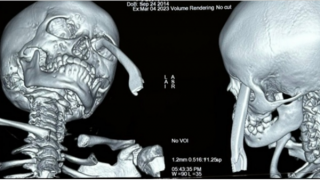 Hai bệnh viện “báo động đỏ” cấp cứu trẻ bị tay thắng xe đâm vào hốc mắt