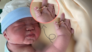 Trường hợp hy hữu: Em bé chào đời cùng vòng tránh thai