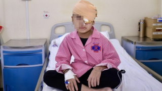 Phẫu thuật cho bé 4 tuổi có u "quái" hốc mắt chiếm gần nửa khuôn mặt