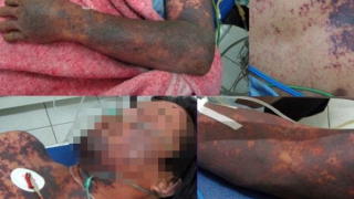 Ăn tiết canh ngan, thịt lợn ốm, hai người bị nhiễm liên cầu lợn nặng