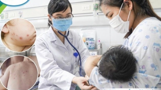Trẻ sơ sinh bị thuỷ đậu biến chứng viêm phổi, suy hô hấp, cha mẹ không được chủ quan