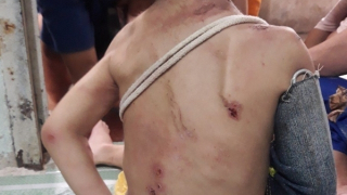 Bé trai 1 tuổi, cơ thể đầy thương tích, nghi bị bạo hành